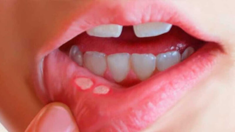 What medicine to take when having canker sores for quick recovery?