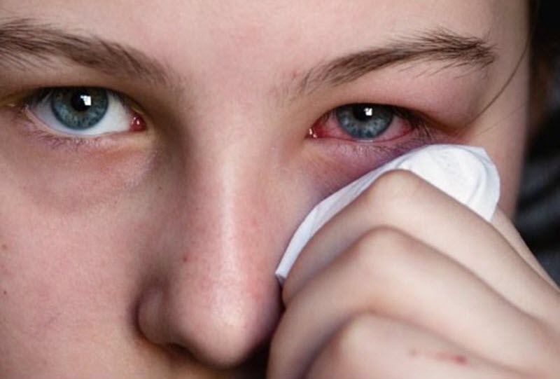 Pocket-friendly Home Remedies for Red Eyes Relief