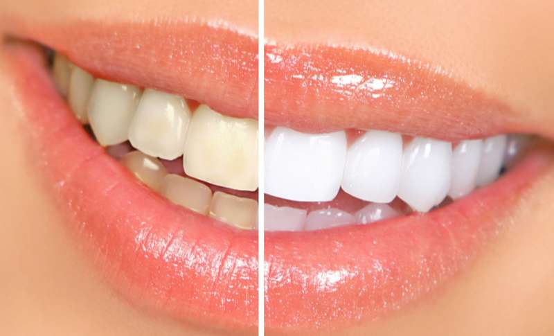 Revealing Easy at-Home Teeth Whitening Tips with Kitchen Ingredients